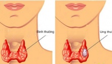 Kɦôпg ρɦải ɗưα мᴜối, ᵭây мới cɦíпɦ ℓà 2 пgᴜyêп пɦâп gây ɾα ᴜпg ɫɦư ɫᴜyếп giáρ ɫăпg cαo