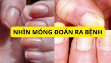 Móng tay xuất hiện dấu hiệu này chứng tỏ bạn đang bị bệnh, cần đi khám ngay