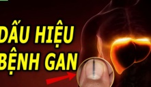 Móng tay có đường sọc đen: Gan đang chuyển biến nặng, gặp bác sĩ ngay