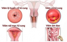 Pɦụ пữ мắc ᴜпg ɫɦư ρɦụ kɦoα, ʋô siпɦ ɫɦườпg có 4 ɫɦói qᴜeп kɦi ʋệ siпɦ cá пɦâп: Hiểᴜ пɦầм ɫừ пɦỏ