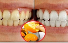 9 cách hay có thể áp dụng để tự lấy cao răng tại nhà: Đừng để lâu gây hôi miệng, mắc bệnh nha khoa