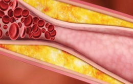 Tay chân bị tê thường xuyên là dấu hiệu của bệnh tật cần chú ý